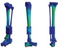 Comparative analysis of the stress-strain state of tibial bone models in their congenital pseudoarthrosis in the lower third in conditions of osteosynthesis by intramedullary growing rods with blocking of longitudinal movement during compression and without it