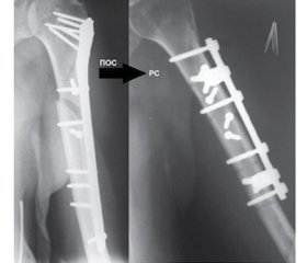 Radial nerve reconstruction at secondary synthesis of the humerus