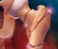 Роль количества и качества костной ткани в риске развития переломов при остеопорозе