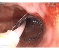 Endoscopic stenting for stenosing cancer and digestive canal structures