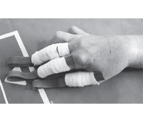Technology for Reposition of Distal Radial Epiphysis Fractures