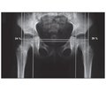 X-Ray Hip Examination in Patients with Cerebral Palsy