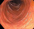 Modern possibilities of colonoprotection in patients with irritable bowel syndrome
