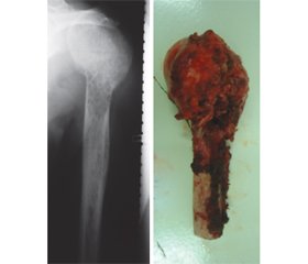 Результати ендопротезування суглобів при хондросаркомі кістки
