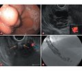 Ендоваскулярне лікування варикозно розширених вен шлунка під контролем ендосонографії