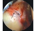 Частота ушкоджень зв’язок, що утримують сухожилок довгої голівки біцепса (pulley lesion), у хворих з адгезивним капсулітом плечового суглоба