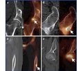 Роль гібридної ОФЕКТ/КТ-візуалізації в діагностичному моніторингу пацієнтів із патологією кісток нижніх кінцівок (огляд літератури)