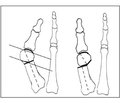 Оптимизация методики предоперационного планирования дистальных остеотомий первой плюсневой кости при оперативной коррекции Hallux Valgus