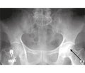 Роль остеосцинтиграфії та рентгенографії у хворих на аваскулярний некроз головки стегнової кістки при ендопротезуванні кульшових суглобів