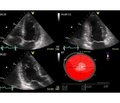 Чинники, що асоціюються з відновленням функції правого шлуночка за даними 2D-спекл-трекінг-ехокардіографії, у хворих на гостру тромбоемболію легеневих артерій