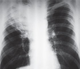 Difficulties of Diagnosis of the Central Endophytic Tumor of the Lungs Arising in the Background of Tuberculosis