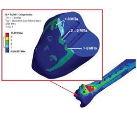 Вибір засобів внутрішньої фіксації при надкісточкових корекційних остеотоміях дистального відділу великогомілкової кістки. Імітаційне комп’ютерне моделювання