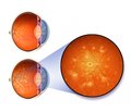 Оптикс Премиум — повышение эффективности лечения диабетической ретинопатии