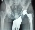 Використання методів фізіотерапії у хворих ортопедо-травматологічного профілю після металоостеосинтезу та ендопротезування