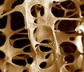The Application of Frax® to Determine Intervention Thresholds in Osteoporosis Treatment in Poland