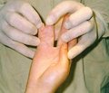 Особенности и основные принципы хирургического лечения врожденных синдактилий пальцев кисти  